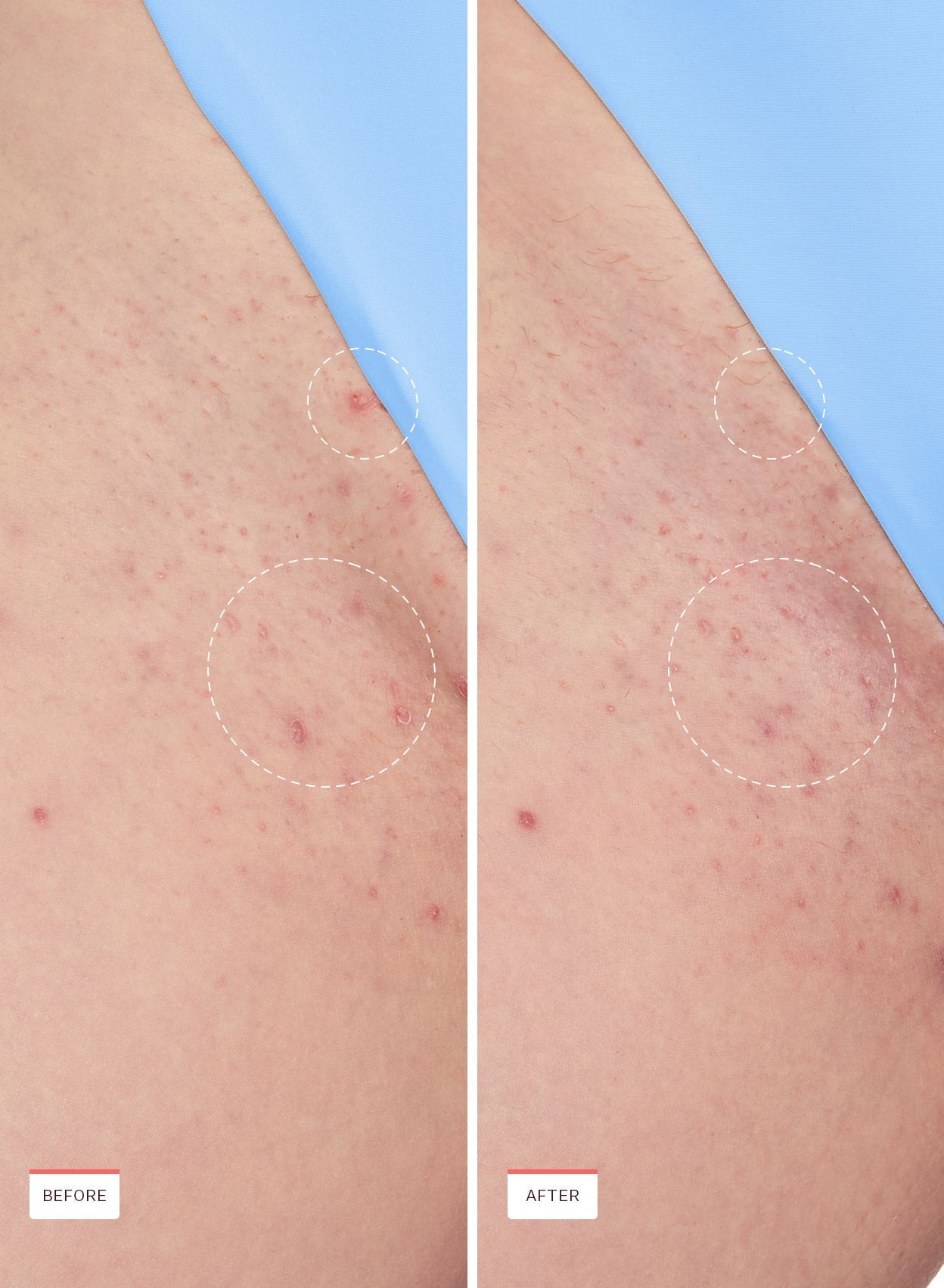 Smoothing Solution Ingrown Hair Treatment