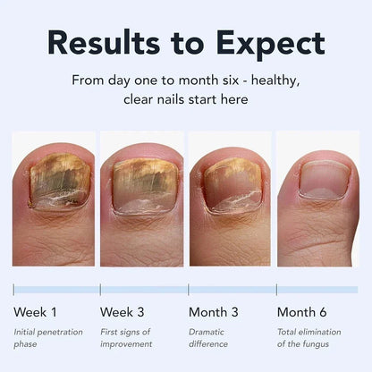 Lunavia Antifungal Pen – 25% Undecylenic Acid Toenail Fungus Treatment Extra-Shop